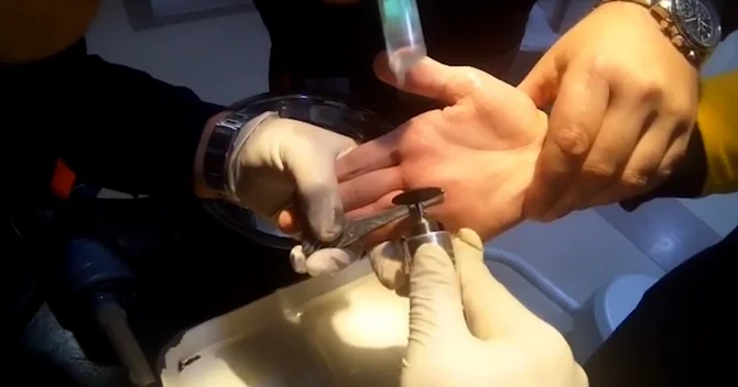 Bakıda 2 nəfərin barmağına üzük sıxışdı, nazirlik köməyə çatdı ANBAAN VİDEO