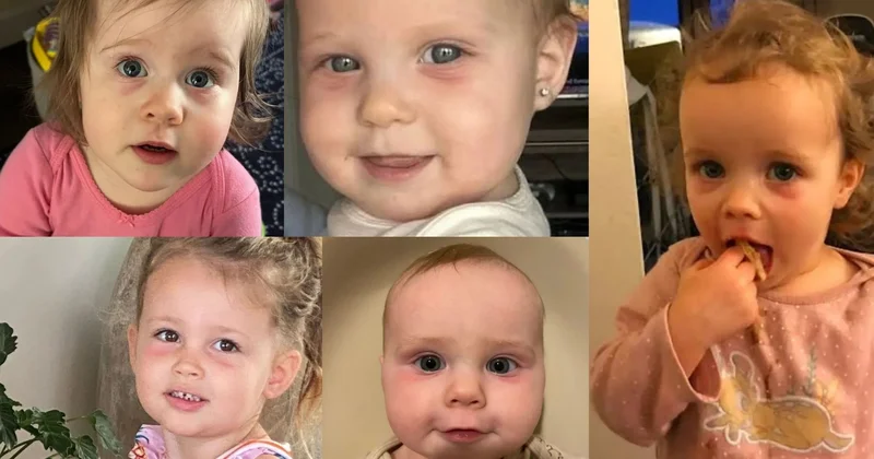 Uşaqların gözlərindəki qızarıqlıq bu xəstəlikdən xəbər verir