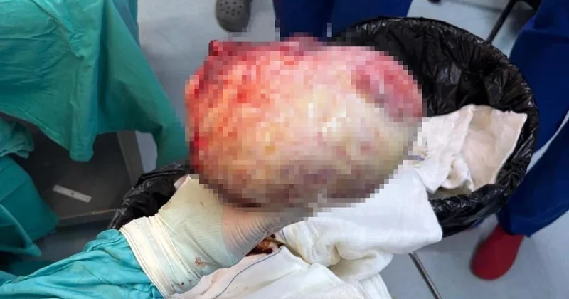 Qadının qarnından 6 kiloqramlıq kista çıxarıldı FOto