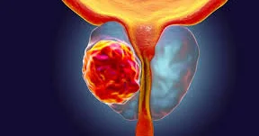 “PAM50 testi ilə prostat xərçəngində fərdi müalicə imkanları“ “National Geographic“