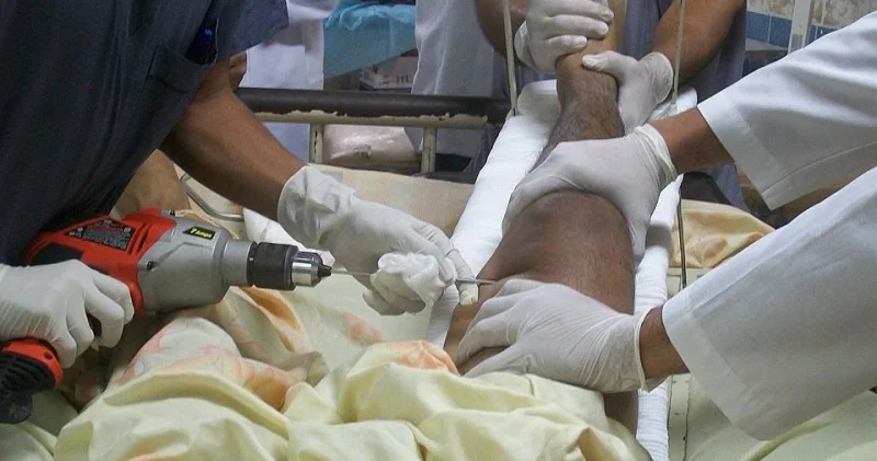 Travmalardan sonra gips mütləqdirmi? Həkim AÇIQLAYIB