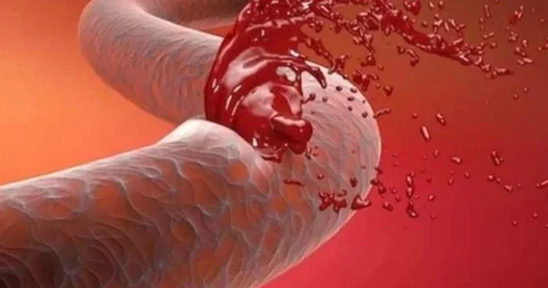 Həkim: Avtomobil qəzalarında daxili qanaxma gizli ola bilər