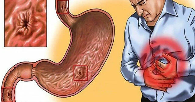 Xroniki qastrit diaqnozu biopsiyasız qoyulmamalıdır AÇIQLAMA