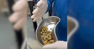Kola içməkdən böyrəkləri daş bağladı Kuryoz olay