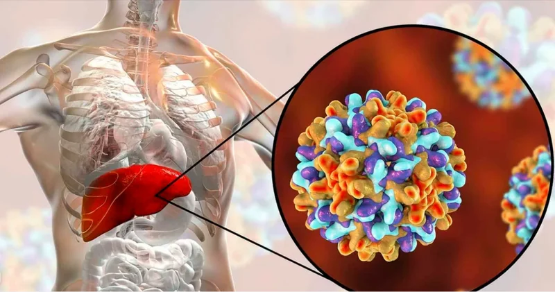 Hepatit: hər 30 saniyədə bir nəfər...