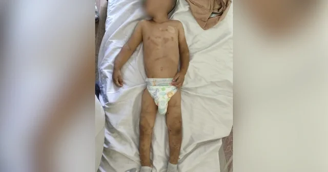 Ağdamda işgəncəyə məruz qalan körpələrin son durumu: Biri Neyrocərrahiyyə Xəstəxanasına aparılıb