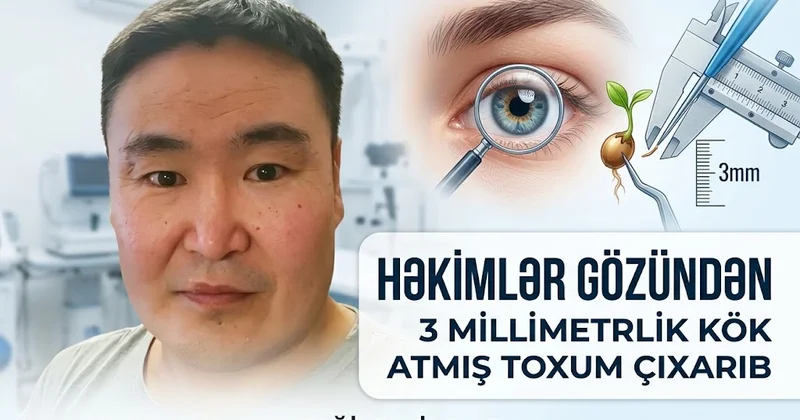 Kişinin gözündə bitki cücərib Qeyri adi tibbi faktlar