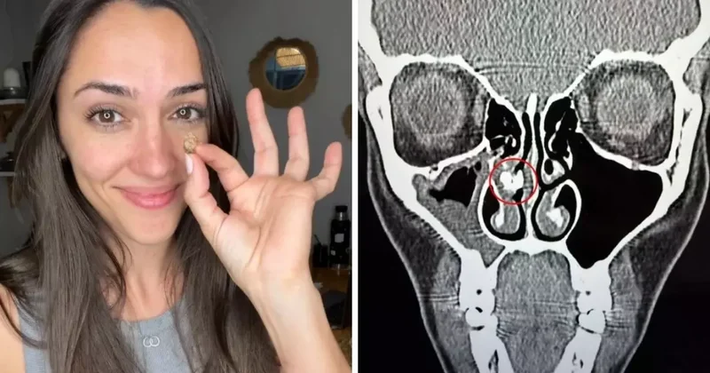 Qadının burnundan görün nə çıxdı 35 ildir belə yaşayıbmış...