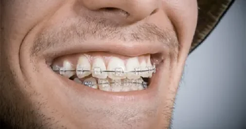 Dişində breket olan oğlanlar əsgərliyə aparılmır? RƏSMİ AÇIQLAMA