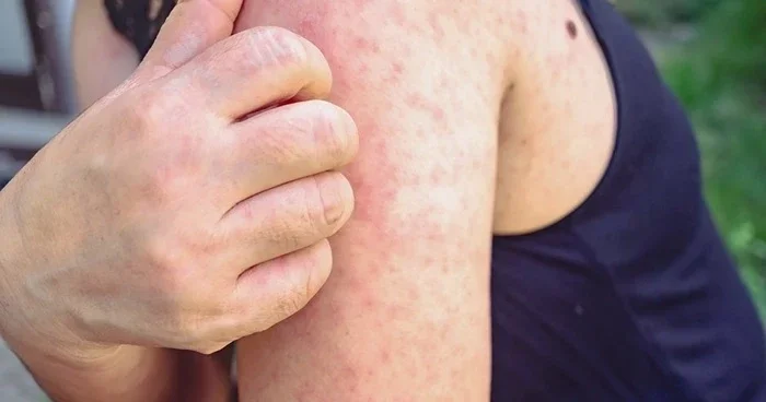 В Шамкирском районе уже три месяца не фиксируются случаи заболевания детей корью