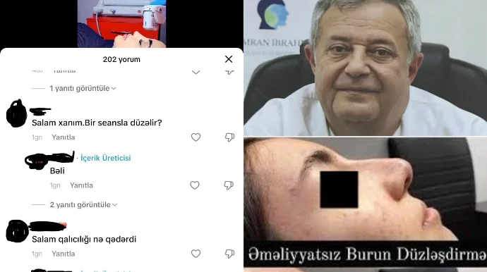 Azərbaycanda yeni fırıldaqçılıq: “BURUN DÜZƏLDƏN” HƏKİM KOSMETOLOQLAR ORTAYA ÇIXIB VİDEO FOTO