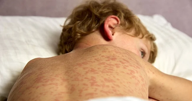 Bu ölkədə 14 min nəfər YOLUXUB