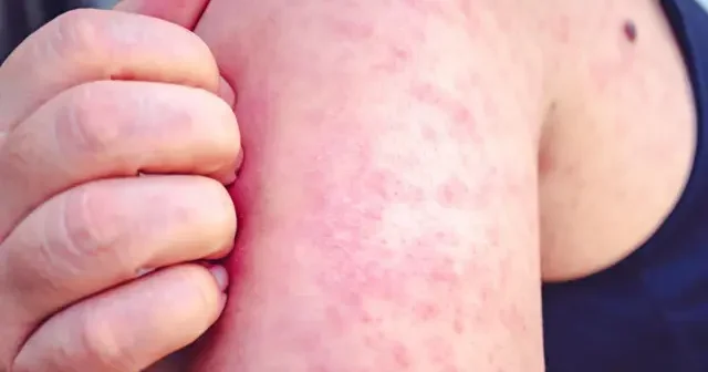 Monqolustanda qızılca xəstəliyinə yoluxanların sayı 14 mini keçib