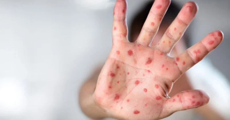Monqolustanda qızılca epidemiyası: Minlərlə yoluxma, ilk ölüm halı