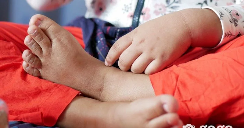 Bu ölkədə qızılca epidemiyası alovlandı