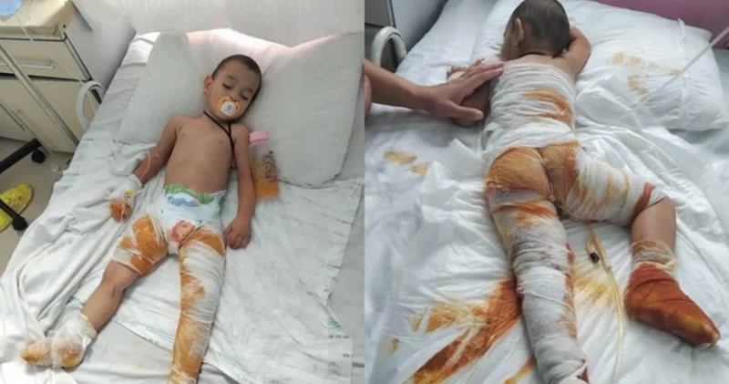 Yanıq xəsarətləri alan iki yaşlı Çimnazın anası fəryad edir: Dəstəyə ehtiyacımız var