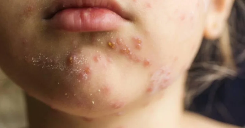 Banqladeşdə qızılca epidemiyası dərinləşir: Ölən uşaqların sayı 712 yə çatdı