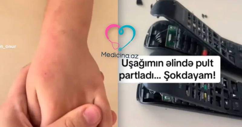 Bakıda azyaşlının əlində pult partladı VİDEO