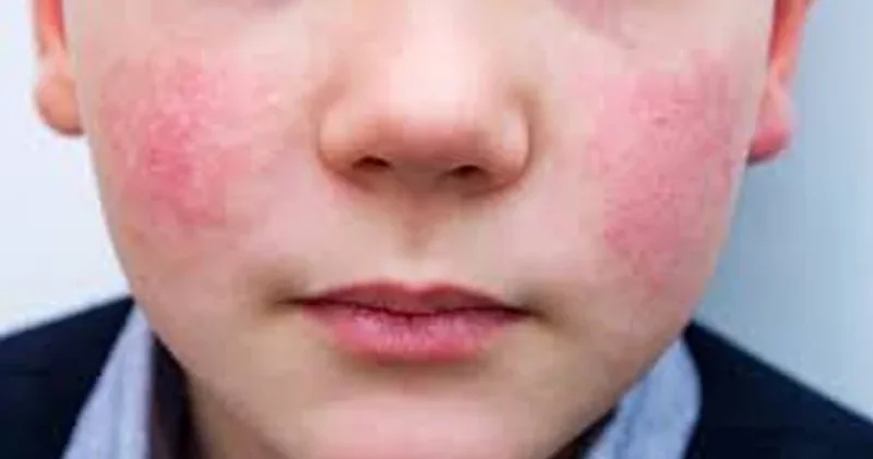 Uşaqlar arasında yeni virus yayıldı: Nələrə diqqət edək?