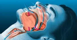 Tibdə ilk Xorultu xərçəng riski ilə əlaqələndirildi