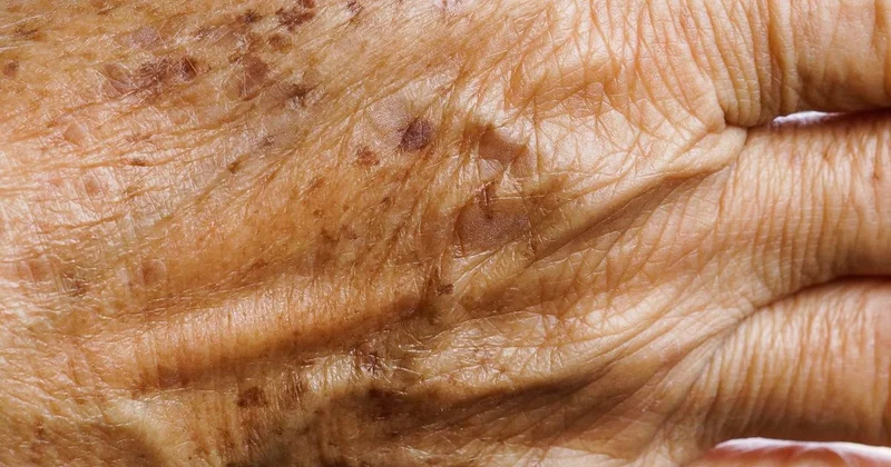 Gündə bir dəfə sürtün Qocalıq ləkələrini yox edir