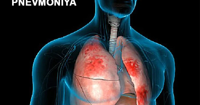 Bakterial meningit daha çox pnevmokokk infeksiyası zamanı yaranan ağırlaşmalardandır PULMONOLOQ