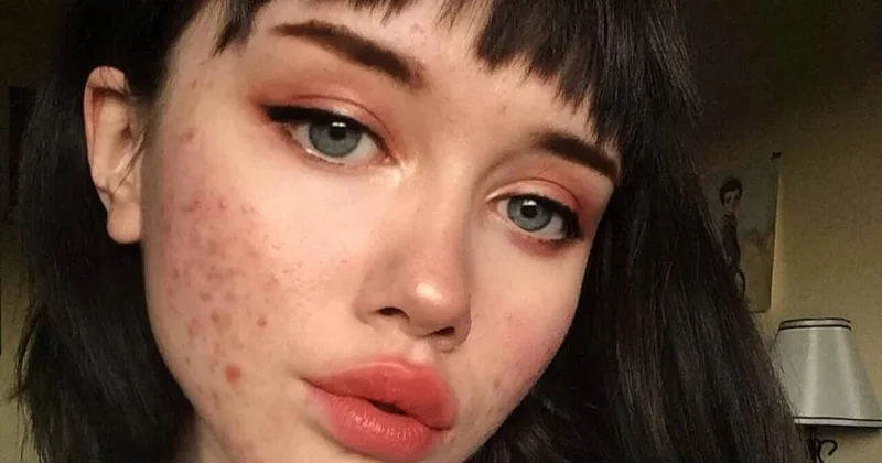 Sızanaqların yaranmasının gözlənilməz səbəbi açıqlandı