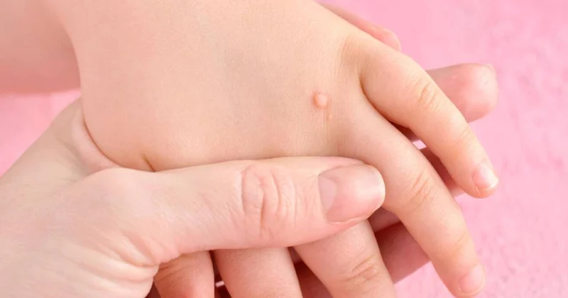 Sarımsaq əzməsini ziyilin üstünə vurun Yox edəcək