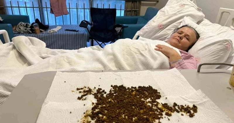 Pasiyentin öd kisəsindən 20 mindən çox daş çıxarılıb