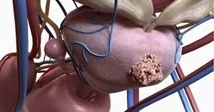 Kişilərdə bu aqressiv xərçəng genetikdir