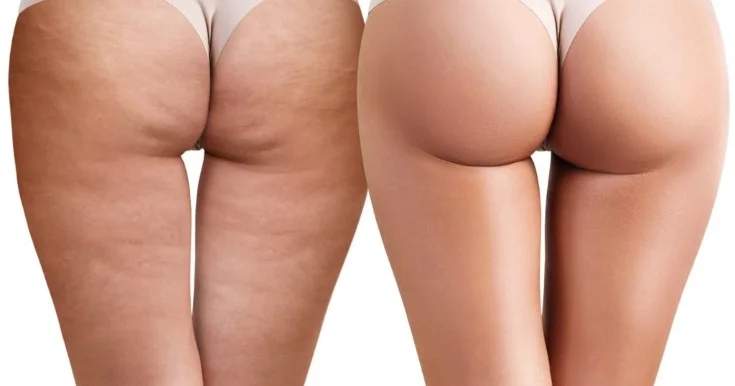 Sellülitləri yox edin