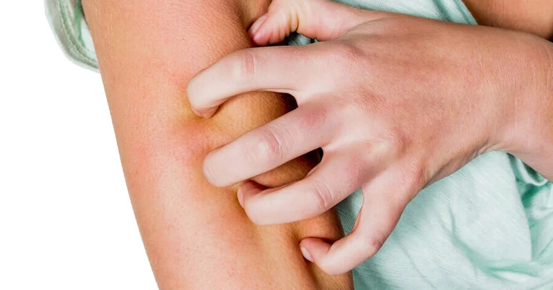 Qaşınma xəstəliyi bu ölkəni cənginə alır Səbəbi bu imiş...