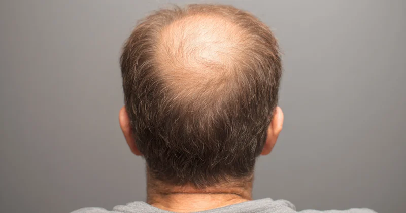 Saç tökülməsinin səbəbi: həkim məşhur yanlış təsəvvürləri dağıdır...