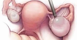 20 yaşlı qızdan qarpız böyüklükdə kista çıxarıldı