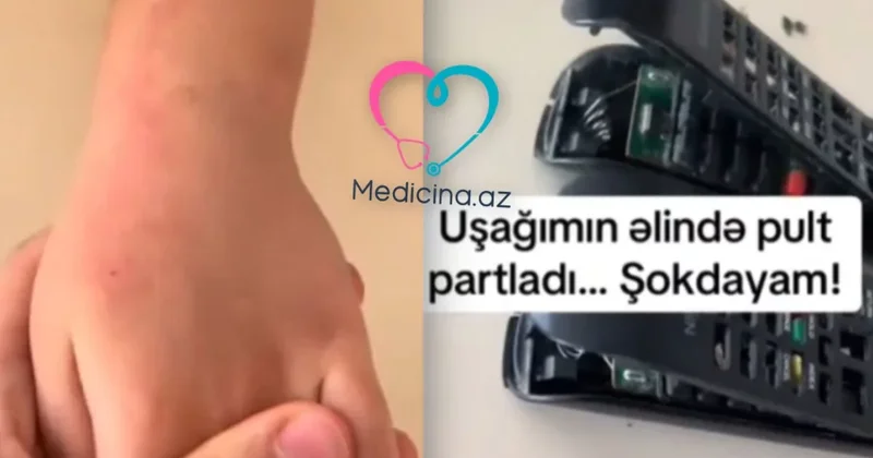 Bakıda azyaşlının əlində pult partladı