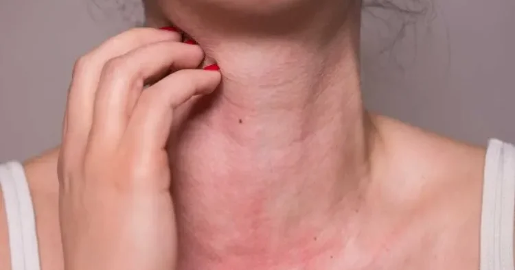 Allergik reaksiyaların artması yay aylarında ciddi narahatlıq doğurur XƏBƏRDARLIQ