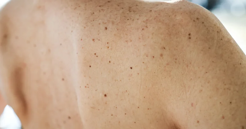 Xəbərdarlıq əlaməti: hansı xallar təcili tibbi yardım tələb edir..?