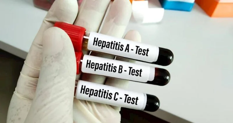 Hepatit C sağalmır? Mütəxəssisdən mühüm AÇIQLAMA