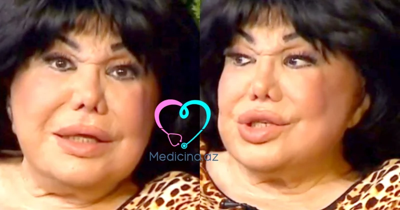 Flora Kərimovanın üzünə nə olub? "Yaxşı deyiləm" VİDEO