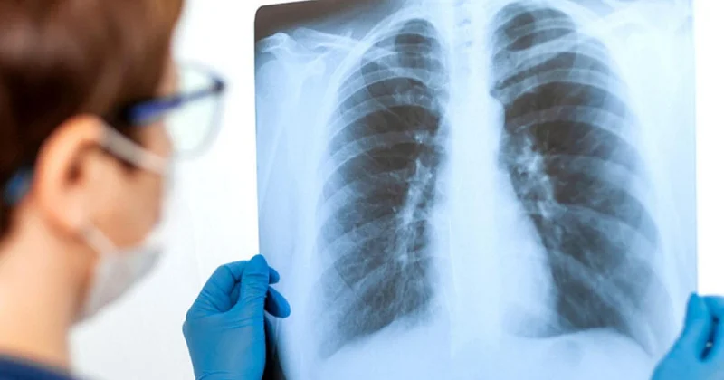 Məktəblilər arasında pnevmoniya sürətlə yayılır XƏBƏRDARLIQ