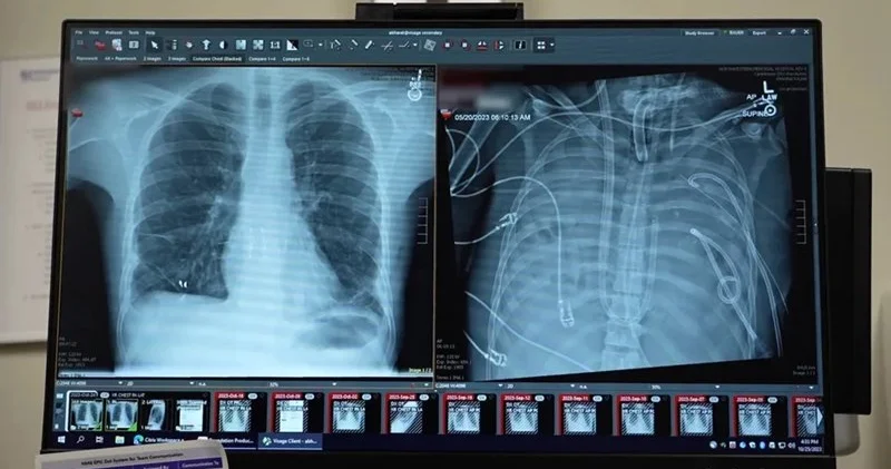 Tibbdə tarixi an: Xəstə ağciyərləri olmadan iki gün yaşadı