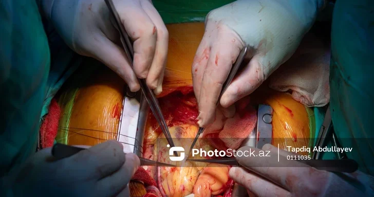 В Азербайджане начнут проводить трансплантации сердца от посмертных доноров