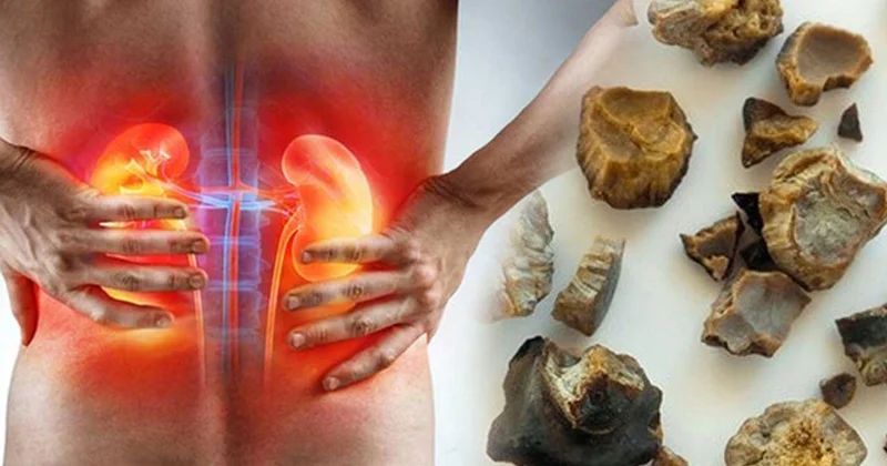 Alimlər böyrək daşlarına yeni çarə TAPDI FOTO