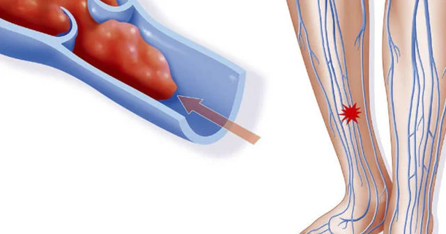 Sağlam damarların sirri: tərəvəz, balıq və qoz fındıq