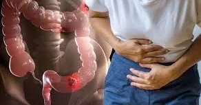 Bu cür qidalanma yoğun bağırsaq şişləri yaradır