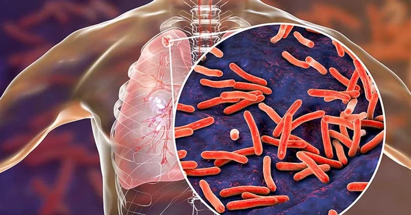Azərbaycanda vərəmə yoluxma halları son 15 ildə əhəmiyyətli dərəcədə azalıb
